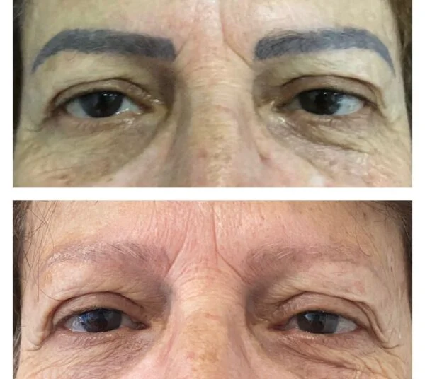 Foto 2 de Remoção de Tatuagem e Micropigmentacão