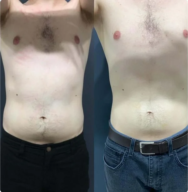 Foto 1 de Lipocavitação