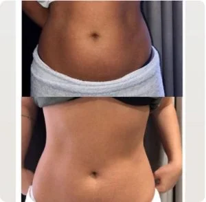 Foto 1 de Velashape 2