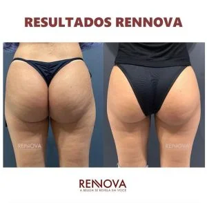 Foto 2 de Velashape 2