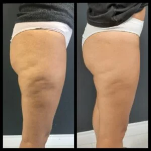 Foto 3 de Velashape