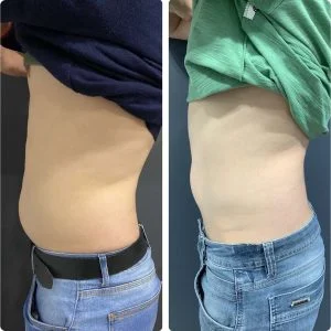 Foto 1 de Exilis Elite