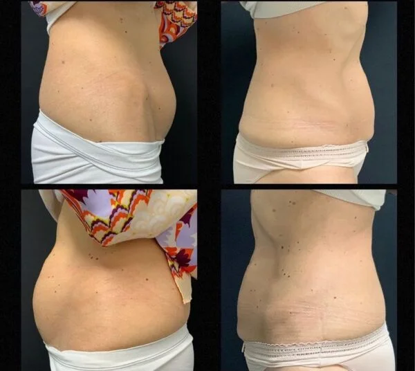Foto 2 de Exilis Elite