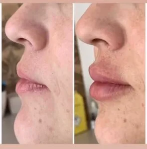Foto 1 de Preenchimento Facial