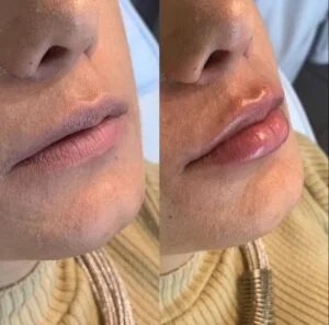 Foto 2 de Preenchimento Facial