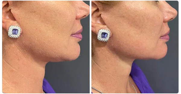 Foto 1 de Ultrassom MICROFOCADO (ULTRAMED HIFU)